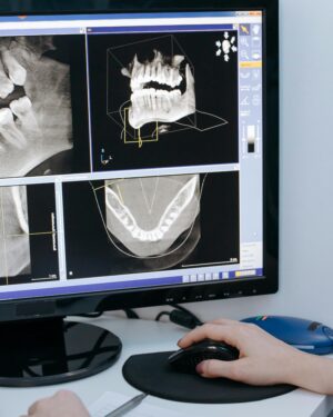Close-up of dental X-ray images displayed on a computer screen for analysis.
